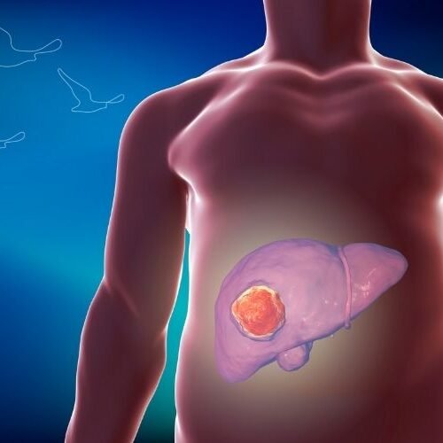 klinist- karaciğer ve safra yolu kanserleri