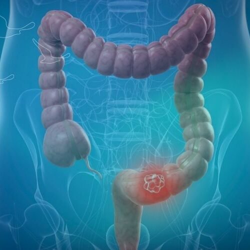 klinist- kolorektal kanserler