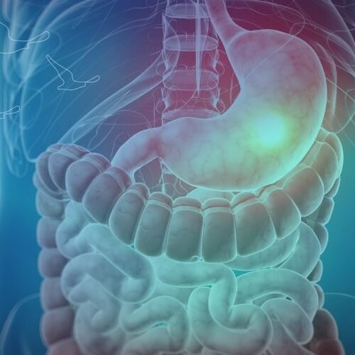 klinist- mide kanseri