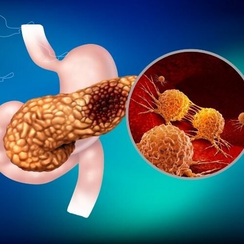 klinist- pankreas kanseri