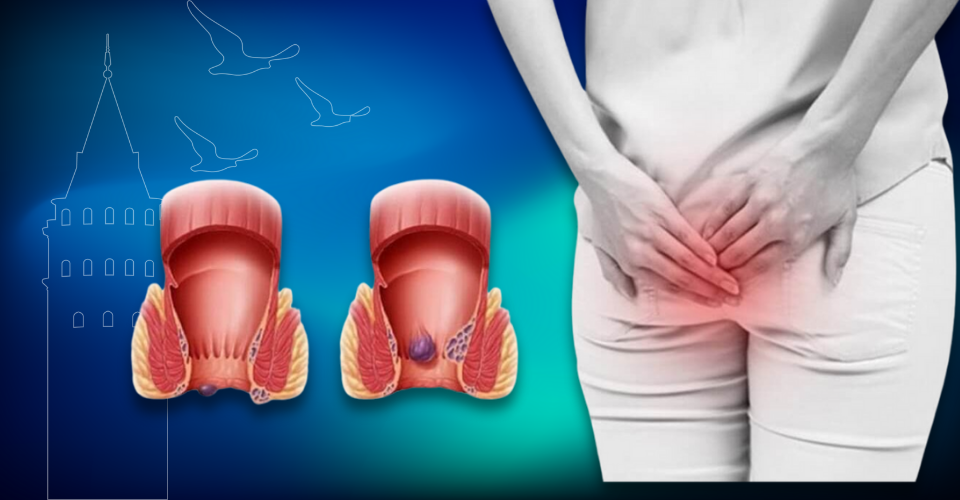 Hemoroid (basur), yaşam kalitesini düşüren ama tedavi edilebilen yaygın bir hastalıktır. Erken tanı için Klinist'e Başvurun.