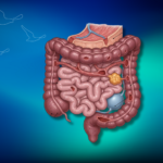 Crohn Fistülleri: İnflamatuar Bağırsak Hastalıklarında Komplikasyonlar