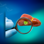 Sıcak Kemoterapi (HIPEC) Nedir? | Klinist