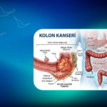 Kolon Kanseri Nedir? Belirtileri, Tanı ve Tedavi | Klinist