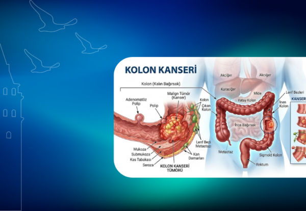 kolon kanseri-klinist